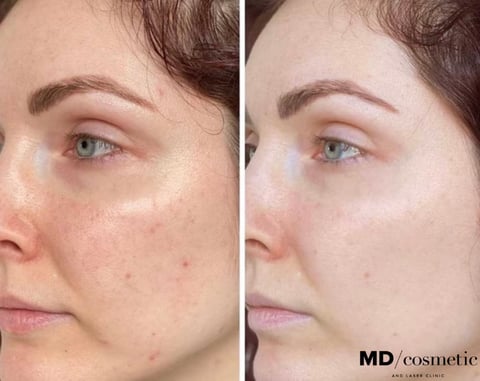 ipl before and after british columbia