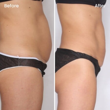 mommy makeover before and after canada