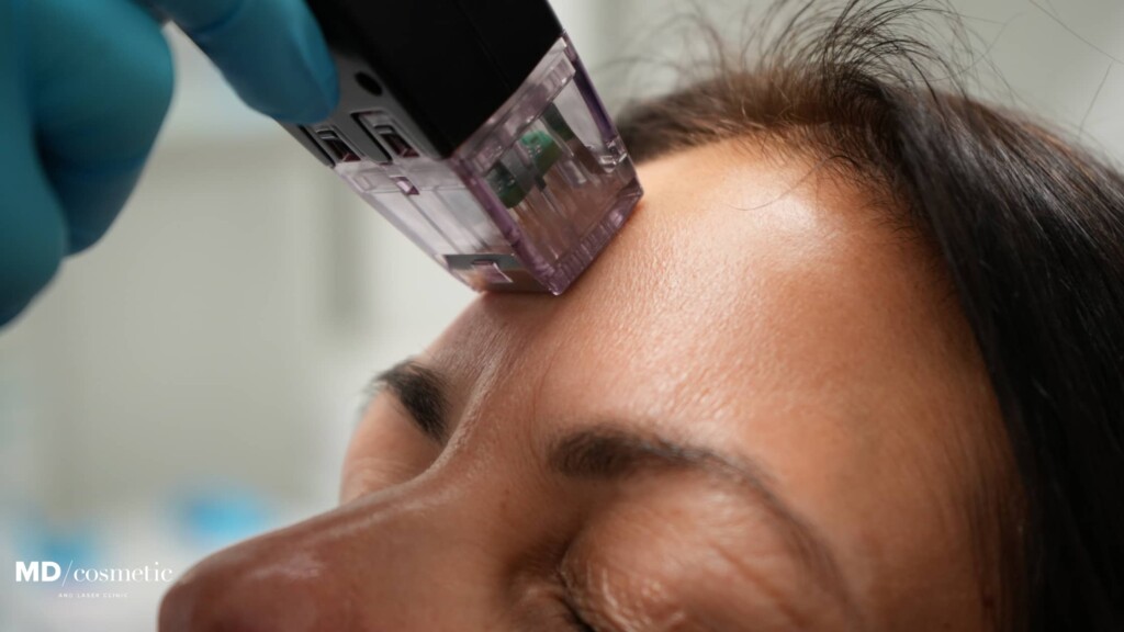 morpheus8 treatment in progress