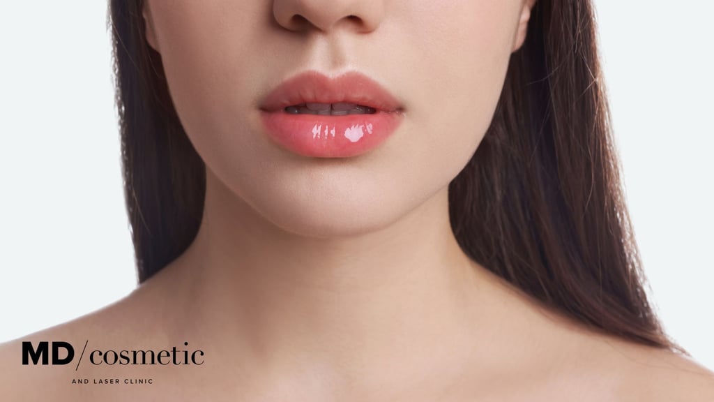subtle lip fillers